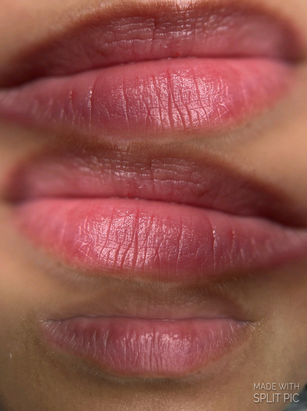 Hydralips