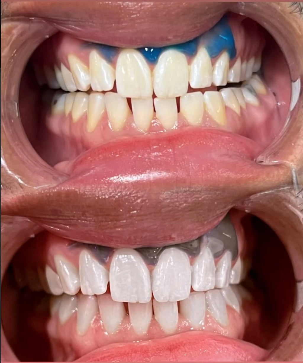 Dental Whitening Training