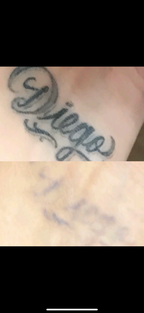 Tattoo Removal Treatment