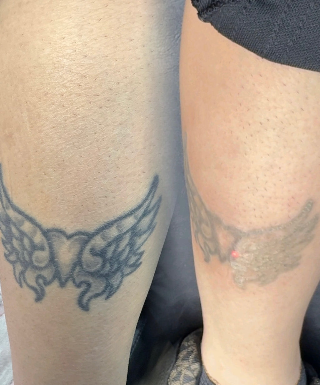 AdvanceTattoo Removal Training