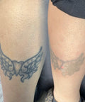 AdvanceTattoo Removal Training