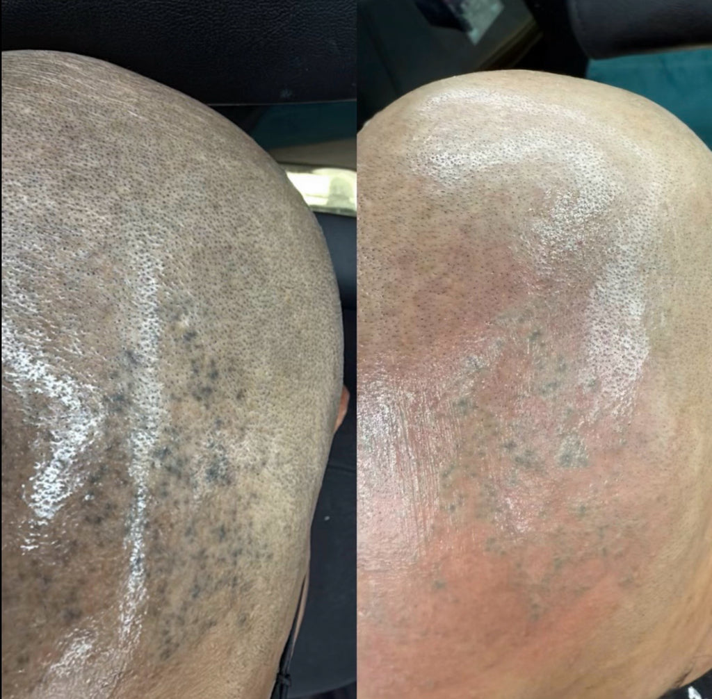 AdvanceTattoo Removal Training