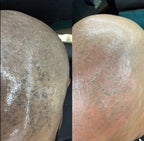 AdvanceTattoo Removal Training