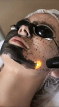 Carbon Peeling